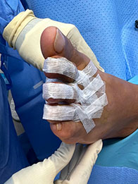 after surgery