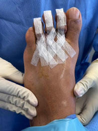 after surgery