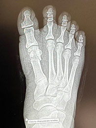 after surgery