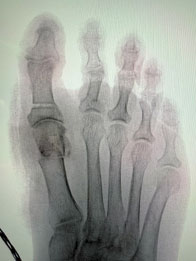 after surgery