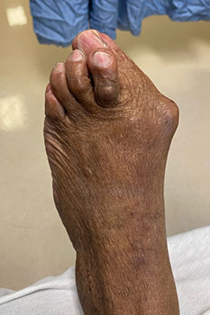 Bunion Condition Before Treatment Bunions condition in the Miami-Dade County, FL: Miami (Hialeah, Opa-locka, Coral Gables, Aventura, Ojus, Westview, Golden Glades, Biscayne Park, Brownsville, Gladeview, Surfside, Bal Harbour, Hialeah Gardens, Medley, Miami Springs, Miami Lakes) areas