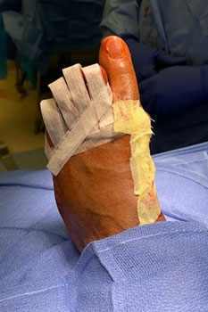 Bunion Removal Bunions treatment in the Miami-Dade County, FL: Miami (Hialeah, Opa-locka, Coral Gables, Aventura, Ojus, Westview, Golden Glades, Biscayne Park, Brownsville, Gladeview, Surfside, Bal Harbour, Hialeah Gardens, Medley, Miami Springs, Miami Lakes) areas