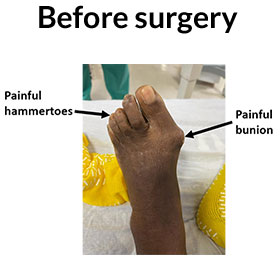 Surgery For Bunions in the Miami-Dade County, FL: Miami (Hialeah, Opa-locka, Coral Gables, Aventura, Ojus, Westview, Golden Glades, Biscayne Park, Brownsville, Gladeview, Surfside, Bal Harbour, Hialeah Gardens, Medley, Miami Springs, Miami Lakes) areas