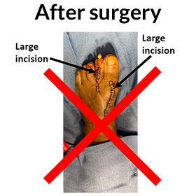 Surgery For Bunions in the Miami-Dade County, FL: Miami (Hialeah, Opa-locka, Coral Gables, Aventura, Ojus, Westview, Golden Glades, Biscayne Park, Brownsville, Gladeview, Surfside, Bal Harbour, Hialeah Gardens, Medley, Miami Springs, Miami Lakes) areas