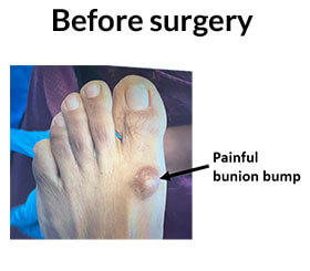 Surgery For Bunions in the Miami-Dade County, FL: Miami (Hialeah, Opa-locka, Coral Gables, Aventura, Ojus, Westview, Golden Glades, Biscayne Park, Brownsville, Gladeview, Surfside, Bal Harbour, Hialeah Gardens, Medley, Miami Springs, Miami Lakes) areas