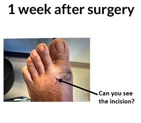 Surgery For Bunions in the Miami-Dade County, FL: Miami (Hialeah, Opa-locka, Coral Gables, Aventura, Ojus, Westview, Golden Glades, Biscayne Park, Brownsville, Gladeview, Surfside, Bal Harbour, Hialeah Gardens, Medley, Miami Springs, Miami Lakes) areas