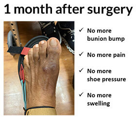 Surgery For Bunions in the Miami, FL 33150 area