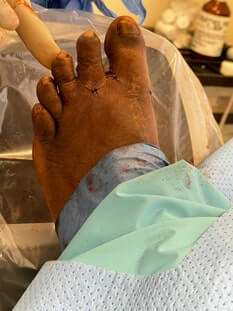 Foot surgery in the Miami-Dade County, FL: Miami (Hialeah, Opa-locka, Coral Gables, Aventura, Ojus, Westview, Golden Glades, Biscayne Park, Brownsville, Gladeview, Surfside, Bal Harbour, Hialeah Gardens, Medley, Miami Springs, Miami Lakes) areas