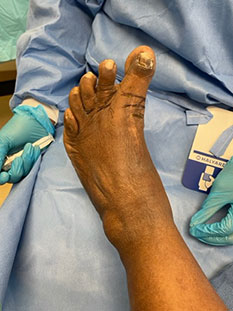 Foot surgery in the Miami-Dade County, FL: Miami (Hialeah, Opa-locka, Coral Gables, Aventura, Ojus, Westview, Golden Glades, Biscayne Park, Brownsville, Gladeview, Surfside, Bal Harbour, Hialeah Gardens, Medley, Miami Springs, Miami Lakes) areas