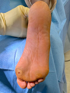 Foot surgery in the Miami-Dade County, FL: Miami (Hialeah, Opa-locka, Coral Gables, Aventura, Ojus, Westview, Golden Glades, Biscayne Park, Brownsville, Gladeview, Surfside, Bal Harbour, Hialeah Gardens, Medley, Miami Springs, Miami Lakes) areas