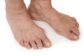 Arthritic foot and ankle care treatment, foot arthritis treatment in the Miami-Dade County, FL: Miami (Hialeah, Opa-locka, Coral Gables, Aventura, Ojus, Westview, Golden Glades, Biscayne Park, Brownsville, Gladeview, Surfside, Bal Harbour, Hialeah Gardens, Medley, Miami Springs, Miami Lakes) areas