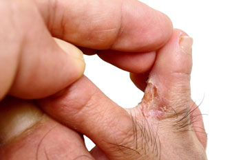 Athletes foot treatment in the Miami-Dade County, FL: Miami (Hialeah, Opa-locka, Coral Gables, Aventura, Ojus, Westview, Golden Glades, Biscayne Park, Brownsville, Gladeview, Surfside, Bal Harbour, Hialeah Gardens, Medley, Miami Springs, Miami Lakes) areas