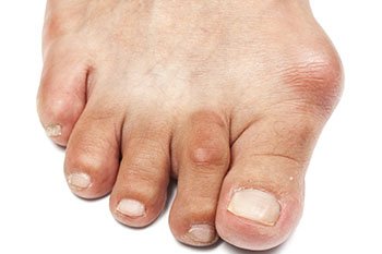 Bunions treatment and removal in the Miami-Dade County, FL: Miami (Hialeah, Opa-locka, Coral Gables, Aventura, Ojus, Westview, Golden Glades, Biscayne Park, Brownsville, Gladeview, Surfside, Bal Harbour, Hialeah Gardens, Medley, Miami Springs, Miami Lakes) areas