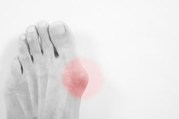 Bunions treatment and removal in the Miami-Dade County, FL: Miami (Hialeah, Opa-locka, Coral Gables, Aventura, Ojus, Westview, Golden Glades, Biscayne Park, Brownsville, Gladeview, Surfside, Bal Harbour, Hialeah Gardens, Medley, Miami Springs, Miami Lakes) areas