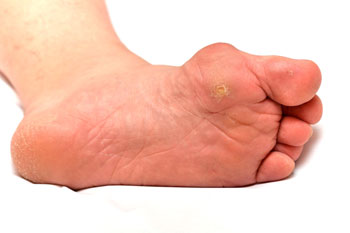 corns treatment in the Miami-Dade County, FL: Miami (Hialeah, Opa-locka, Coral Gables, Aventura, Ojus, Westview, Golden Glades, Biscayne Park, Brownsville, Gladeview, Surfside, Bal Harbour, Hialeah Gardens, Medley, Miami Springs, Miami Lakes) areas