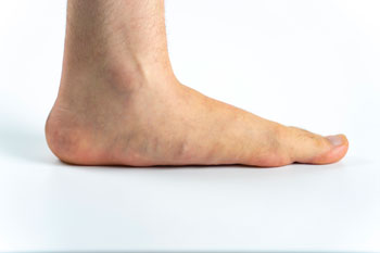 flat feet