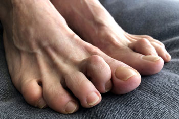 Hammertoe Treatment in the Miami-Dade County, FL: Miami (Hialeah, Opa-locka, Coral Gables, Aventura, Ojus, Westview, Golden Glades, Biscayne Park, Brownsville, Gladeview, Surfside, Bal Harbour, Hialeah Gardens, Medley, Miami Springs, Miami Lakes) areas