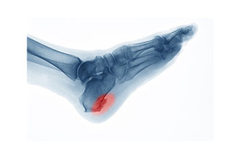 Heel spurs treatment in the Miami-Dade County, FL: Miami (Hialeah, Opa-locka, Coral Gables, Aventura, Ojus, Westview, Golden Glades, Biscayne Park, Brownsville, Gladeview, Surfside, Bal Harbour, Hialeah Gardens, Medley, Miami Springs, Miami Lakes) areas