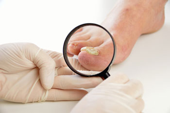 Fungal toenails, toenail fungus diagnosis and treatment in the Miami-Dade County, FL: Miami (Hialeah, Opa-locka, Coral Gables, Aventura, Ojus, Westview, Golden Glades, Biscayne Park, Brownsville, Gladeview, Surfside, Bal Harbour, Hialeah Gardens, Medley, Miami Springs, Miami Lakes) areas