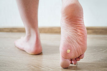Plantar warts treatment in the Miami-Dade County, FL: Miami (Hialeah, Opa-locka, Coral Gables, Aventura, Ojus, Westview, Golden Glades, Biscayne Park, Brownsville, Gladeview, Surfside, Bal Harbour, Hialeah Gardens, Medley, Miami Springs, Miami Lakes) areas
