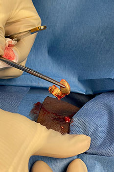 Wound Care Practice Wound and ulcers care treatment in the Miami-Dade County, FL: Miami (Hialeah, Opa-locka, Coral Gables, Aventura, Ojus, Westview, Golden Glades, Biscayne Park, Brownsville, Gladeview, Surfside, Bal Harbour, Hialeah Gardens, Medley, Miami Springs, Miami Lakes) areas