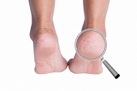 Exploring Underlying Causes of Cracked Heels