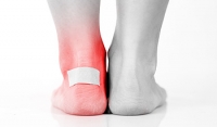 Possible Treatment for Blisters on the Feet